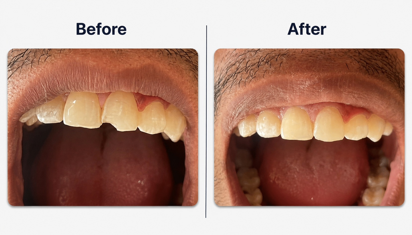 Chipped & Uneven Front Teeth Restored