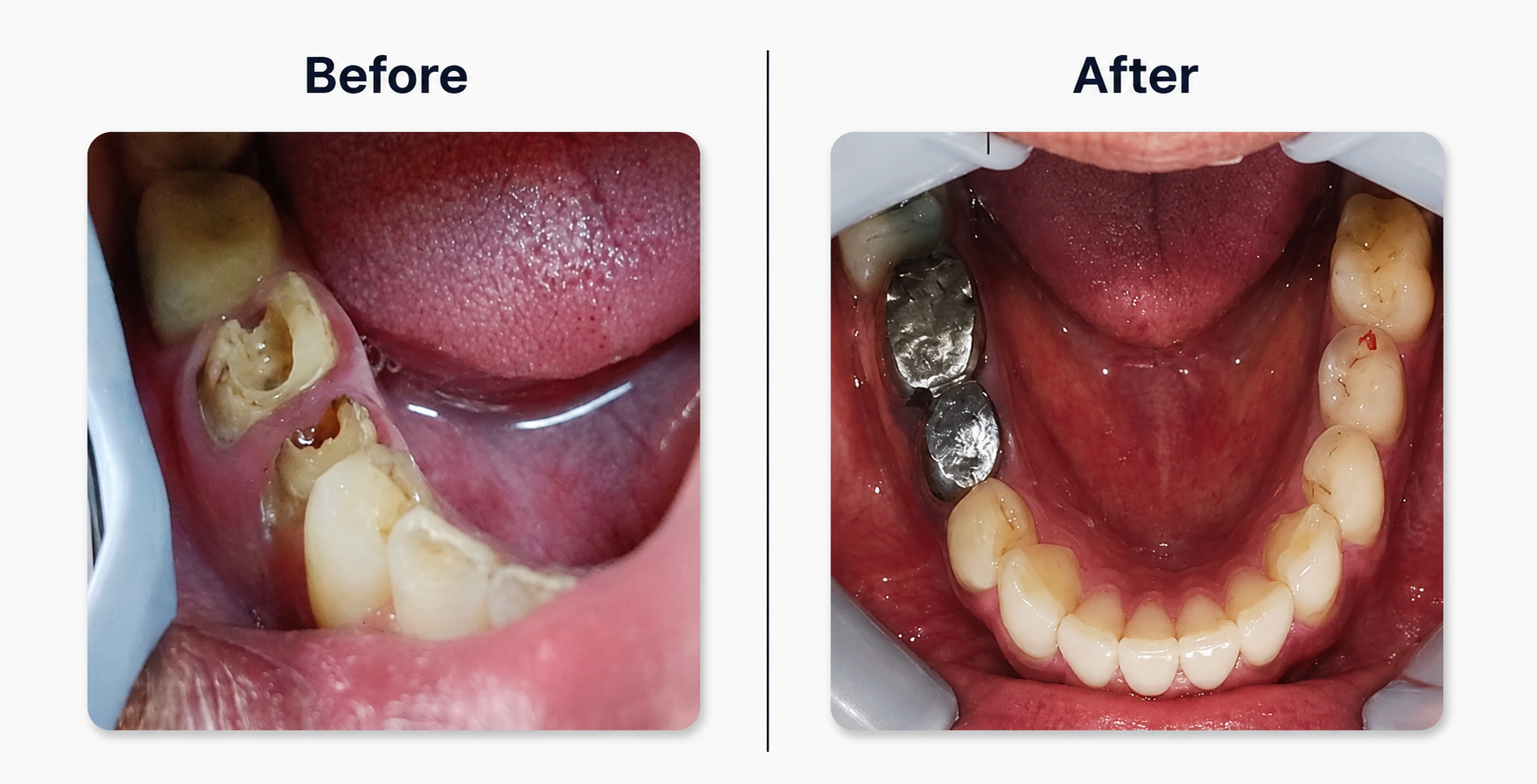 Full Arch Restoration