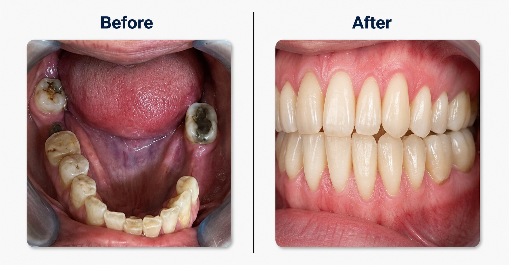 Complete Smile Makeover
